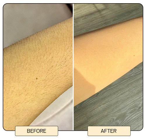 IPL Laser Hair Removal Device – At-Home Treatment for Face, Legs, Bikini & More Safe for All Skin Tones